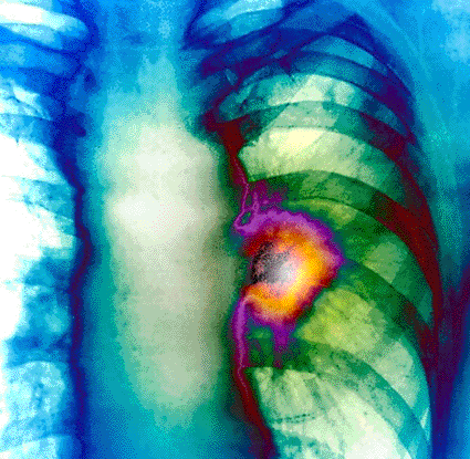 Image: Colored X-ray of the left lung in a patient with lung cancer (Photo courtesy of Zephyr / SPL).